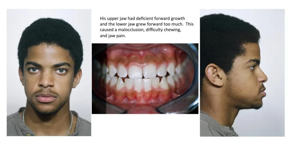 His upper jaw had deficient forward growth and the lower jaw grew forward too much. This caused a malocclusion, difficulty chewing, and jaw pain.