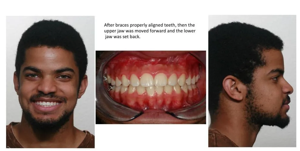 After braces properly aligned teeth, then the upper jaw was moved forward and the lower jaw was set back.