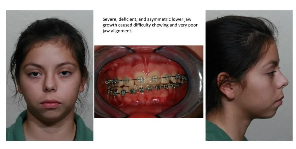 Severe, deficient, and asymmetric lower jaw growth caused difficulty chewing and very poor jaw alignment.