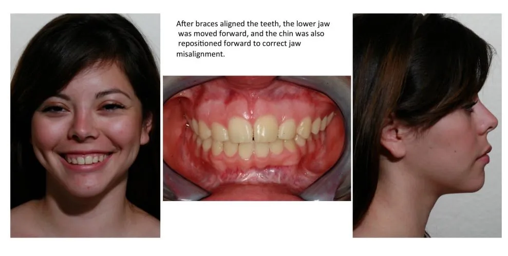 After braces aligned the teeth, the lower jaw was moved forward, and the chin was also repositioned forward to correct jaw misalignment.