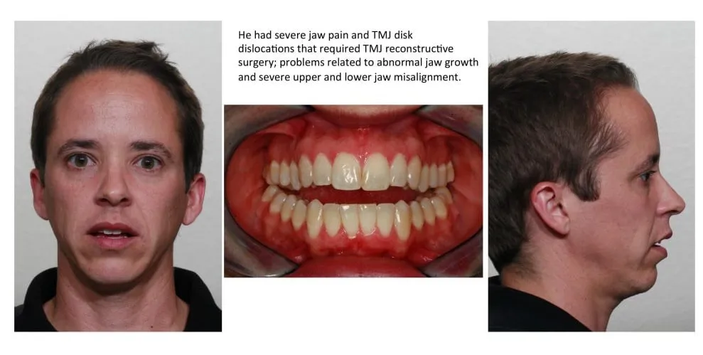 He had severe jaw pain and TMJ disk dislocation that require TMJ reconstructive surgery; problems related to abnormal jaw growth and severe upper and lower jas misalignment.