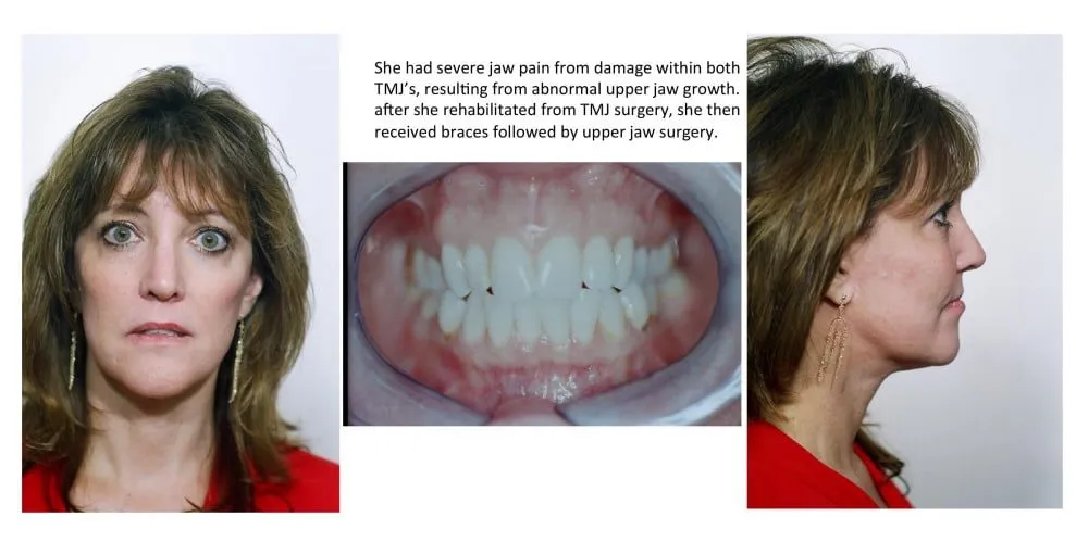 She had a severe jaw pain from damage with both TMJ's resulting from abnormal upper jaw growth. After she rehabilitated from TMJ surgery, she then received braces followed by upper jaw surgery.