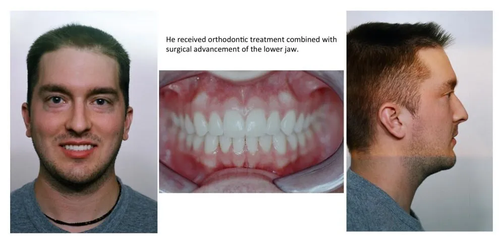 He received orthodontic treatment combined with the surgical advancement of the lower jaw.