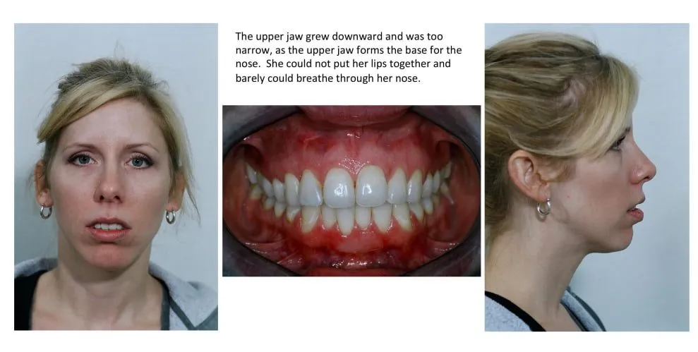 The upper jaw grew downward and was too narrow, as the upper jaw forms the base for the nose. She could not put her lips together and barely could breathe through her nose.