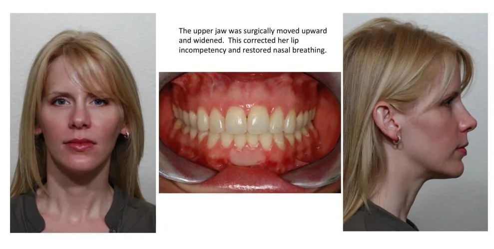 The upper jaw was surgically moved upward and widened. This corrected her lip incompetency and restored nasal breathing.