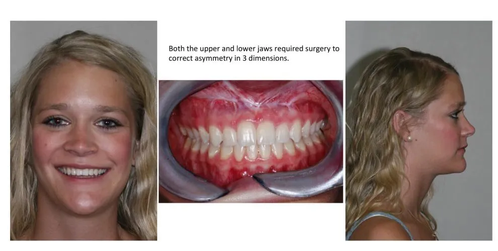 Both the upper and lower jaw required surgery to correct asymmetry in 3 dimensions.